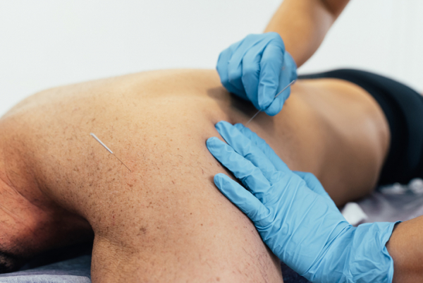 What is Dry Needling