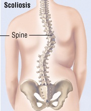 PhysioPartners’ Position Statement on Scoliosis Screening and Treatment