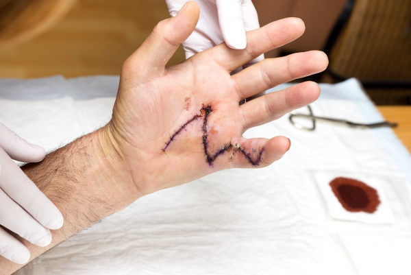 Stabbing Pain After Carpal Tunnel Surgery