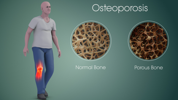 HOW TO SLOW DOWN OSTEOPOROSIS