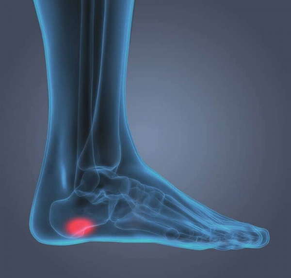 WHAT TO DO FOR HEEL PAIN