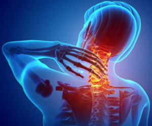 PHYSICAL THERAPY FOR NECK PAIN