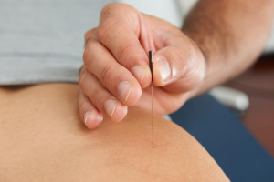 What is Dry Needling and who is it good for?