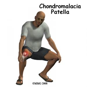CHONDROMALACIA PATELLA Complete Injury Guide