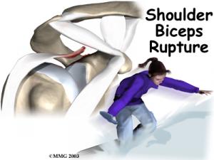 BICEPS RUPTURE Complete Injury Guide