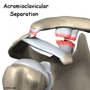 AC JOINT SEPARATION Complete Injury Guide