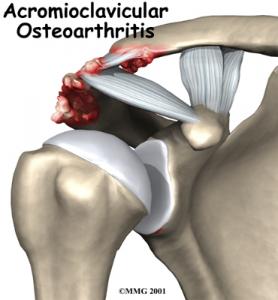 AC JOINT ARTHRITIS Complete Injury Guide