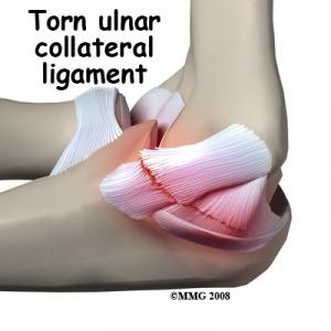 UCL (ULNAR COLLATERAL LIGAMENT) Complete Injury Guide