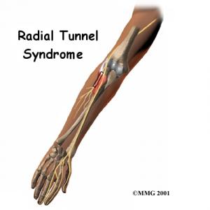 RADIAL TUNNEL SYNDROME Complete Injury Guide