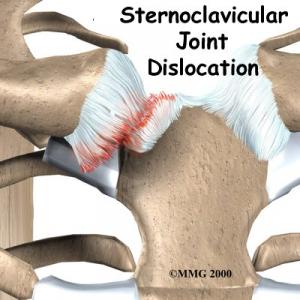 STERNOCLAVICULAR JOINT Complete Injury Guide