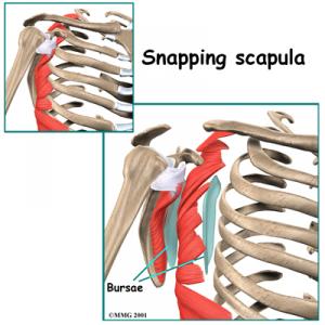 SNAPPING SCAPULA SYNDROME Complete Injury Guide