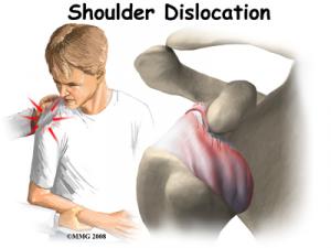 SHOULDER DISLOCATION Complete Injury Guide