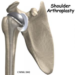 SHOULDER REPLACEMENT Complete Surgical Guide