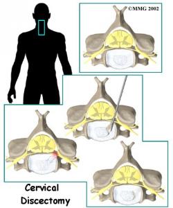CERVICAL DISCECTOMY Complete Surgical Guide