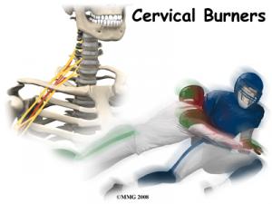 CERVICAL BURNERS/STINGERS Complete Injury Guide