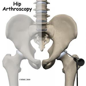 HIP ARTHROSCOPY Surgery Guide