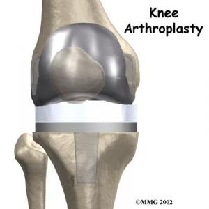 TOTAL KNEE REPLACEMENT Surgery Guide