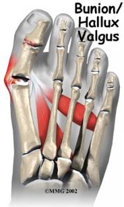 BUNIONS Complete Injury Guide