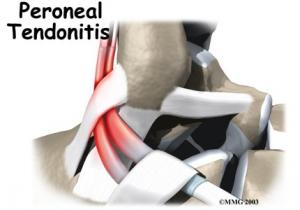 PERONEAL TENDON Complete Injury Guide